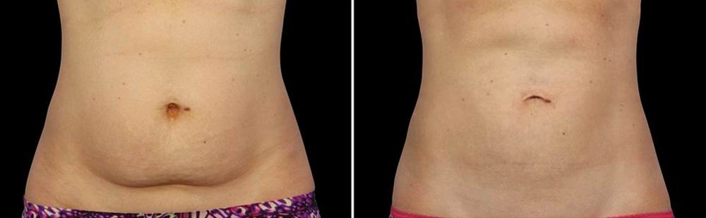 How Much Is CoolSculpting?